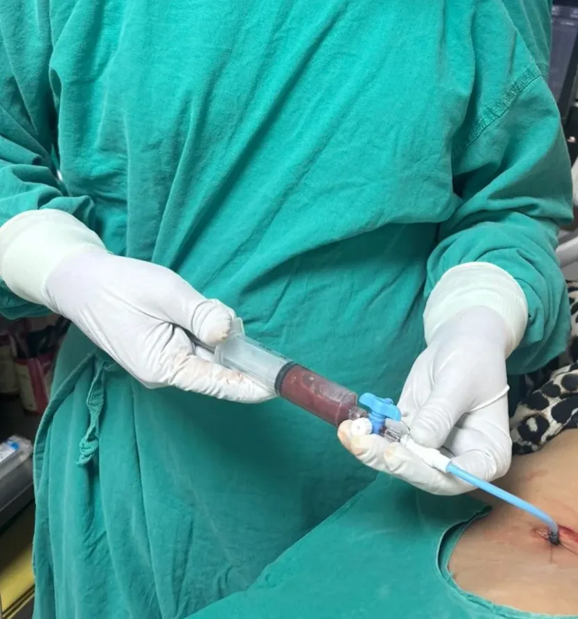 PCN For Renal Abscess